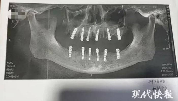 چینی شہری نے ایک ہی دن میں 23 دانت نکلوانے کے بعد 12 نئے لگوالیے